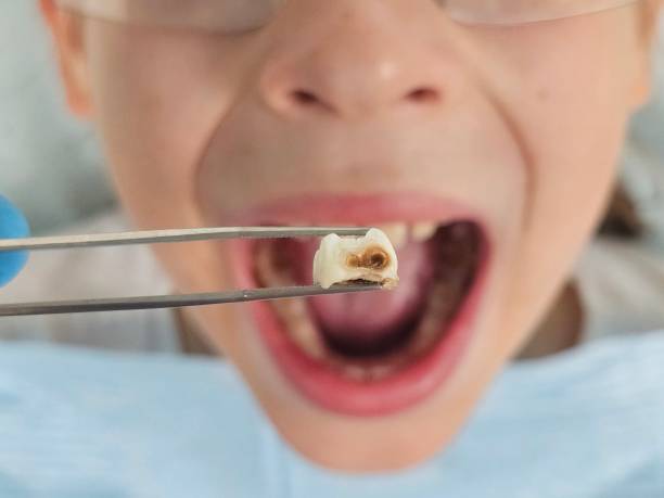 Best Urgent Tooth Repair  in Hanley Hills, MO
